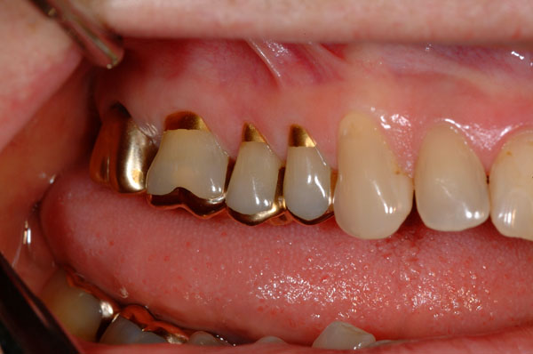 Dr. Robert Allen 02 Existing Gold Foil Restorations