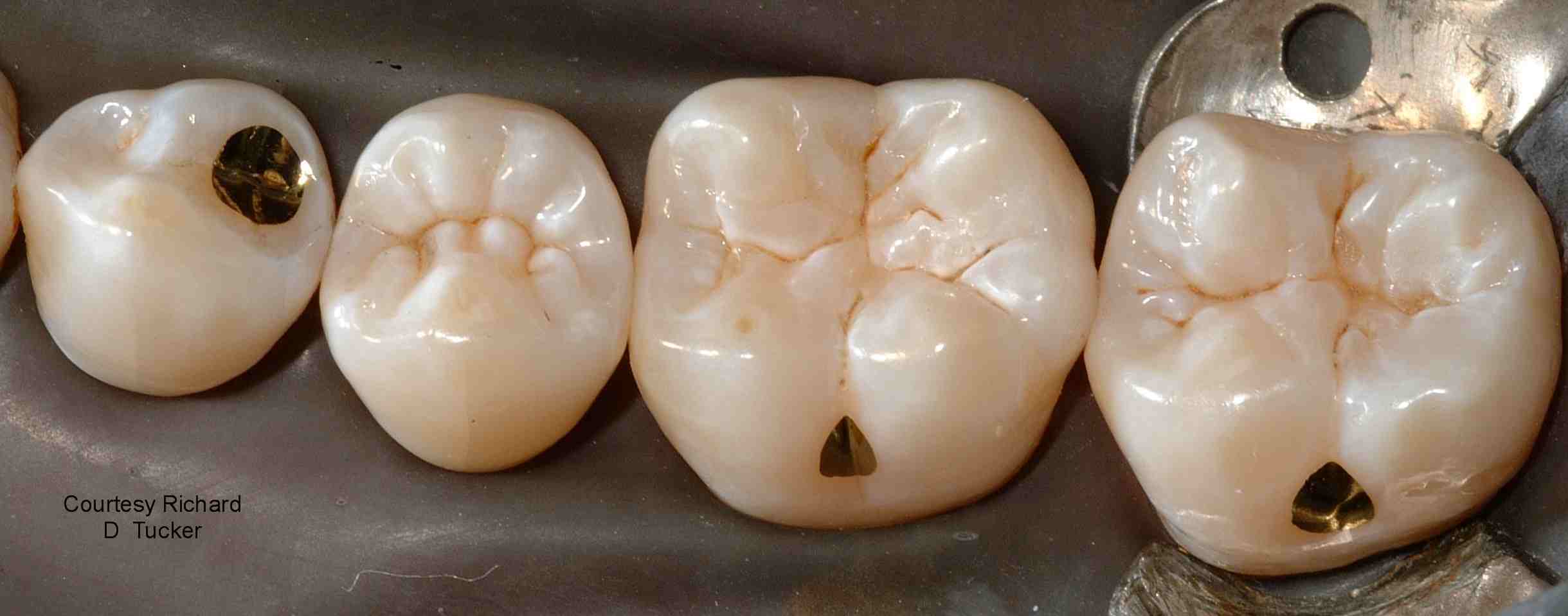 Amalgam Restorations And The Gold Standard For